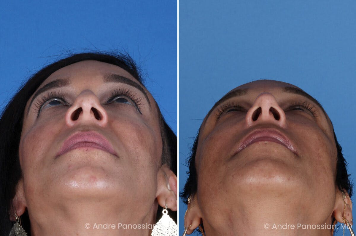Rhinoplasty Before & After Gallery - Patient 319593 - Image 8