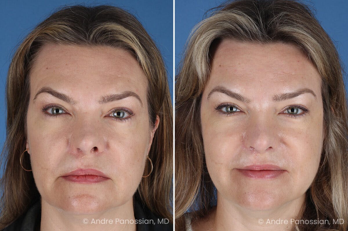 Cleft Lip Rhinoplasty Before & After Gallery - Patient 385231 - Image 2