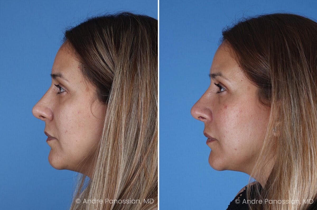Revision Rhinoplasty Before & After Gallery - Patient 185311 - Image 4