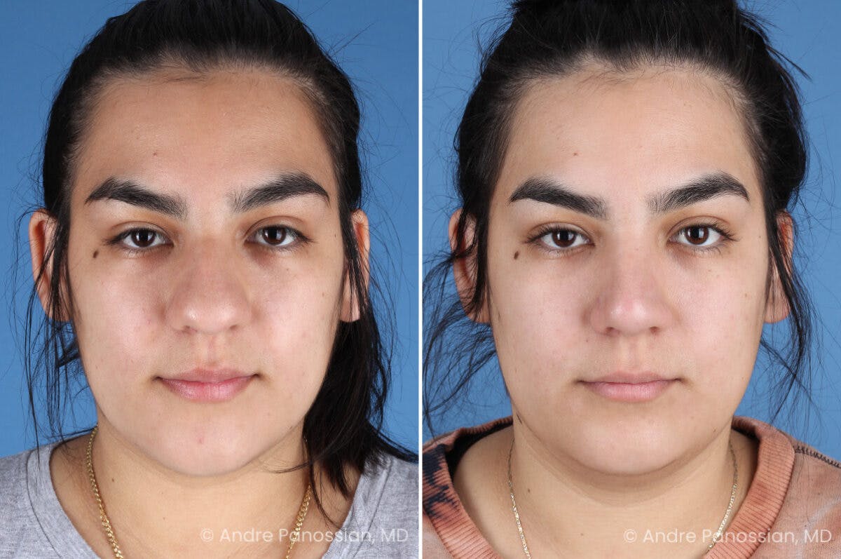 Rhinoplasty Before & After Gallery - Patient 131106 - Image 2