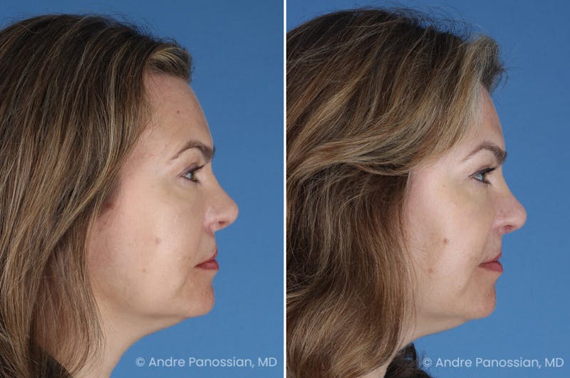 Cleft Lip Rhinoplasty Before & After Gallery - Patient 385231 - Image 1