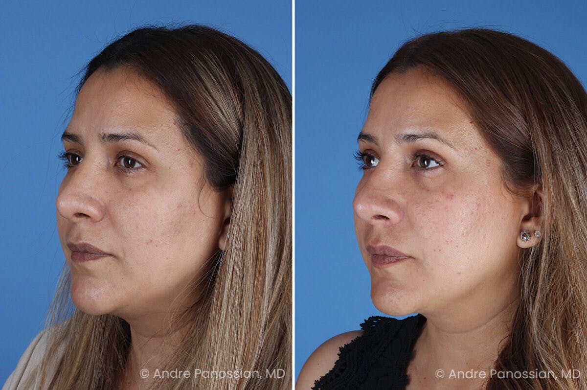 Revision Rhinoplasty Before & After Gallery - Patient 185311 - Image 5