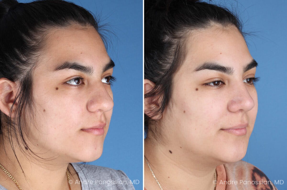 Rhinoplasty Before & After Gallery - Patient 131106 - Image 3