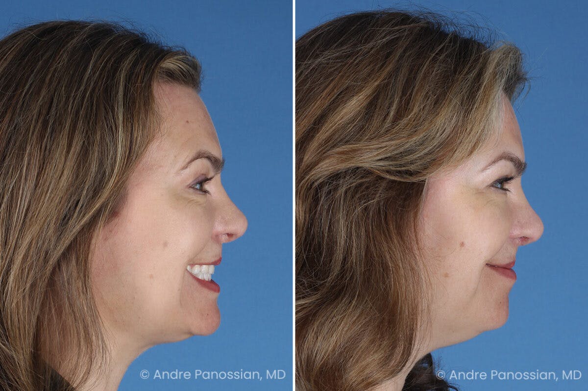 Cleft Lip Rhinoplasty Before & After Gallery - Patient 385231 - Image 3