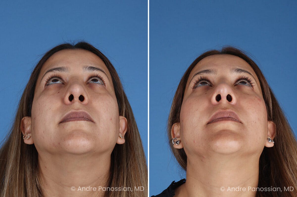 Revision Rhinoplasty Before & After Gallery - Patient 185311 - Image 6