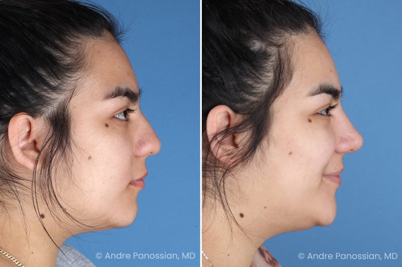 Rhinoplasty Before & After Gallery - Patient 131106 - Image 1