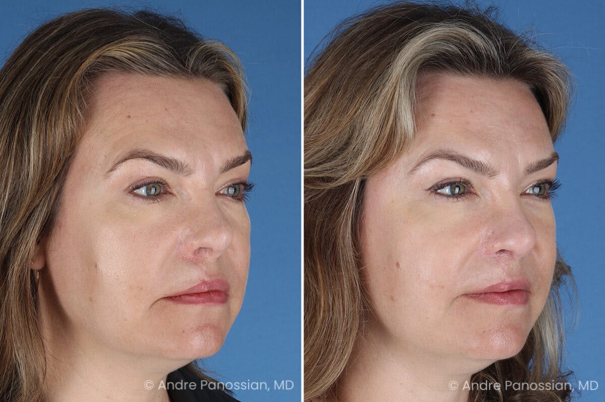 Cleft Lip Rhinoplasty Before & After Gallery - Patient 385231 - Image 4