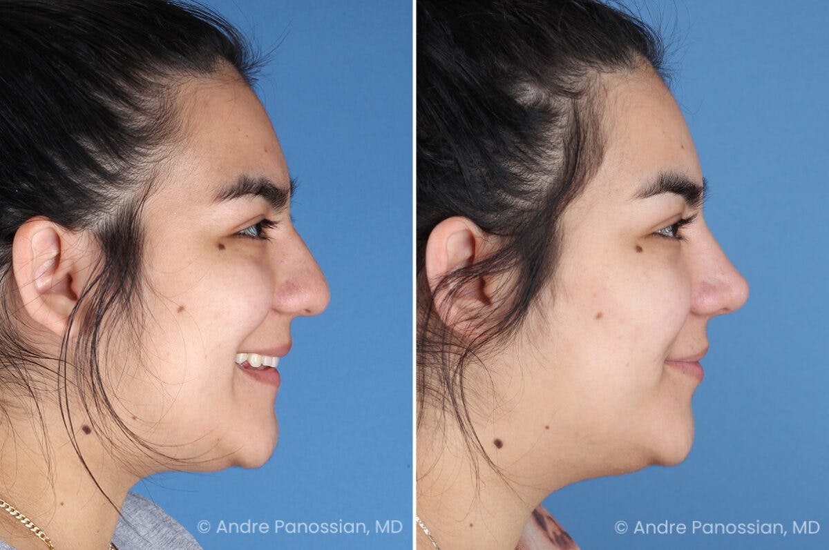 Rhinoplasty Before & After Gallery - Patient 131106 - Image 4