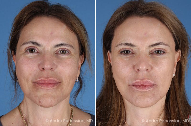 Facelift & Neck Lift Before & After Gallery - Patient 219610 - Image 1