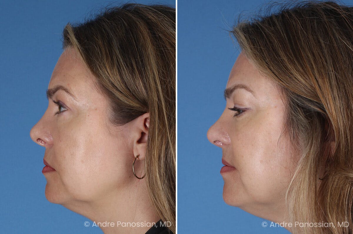 Cleft Lip Rhinoplasty Before & After Gallery - Patient 385231 - Image 5