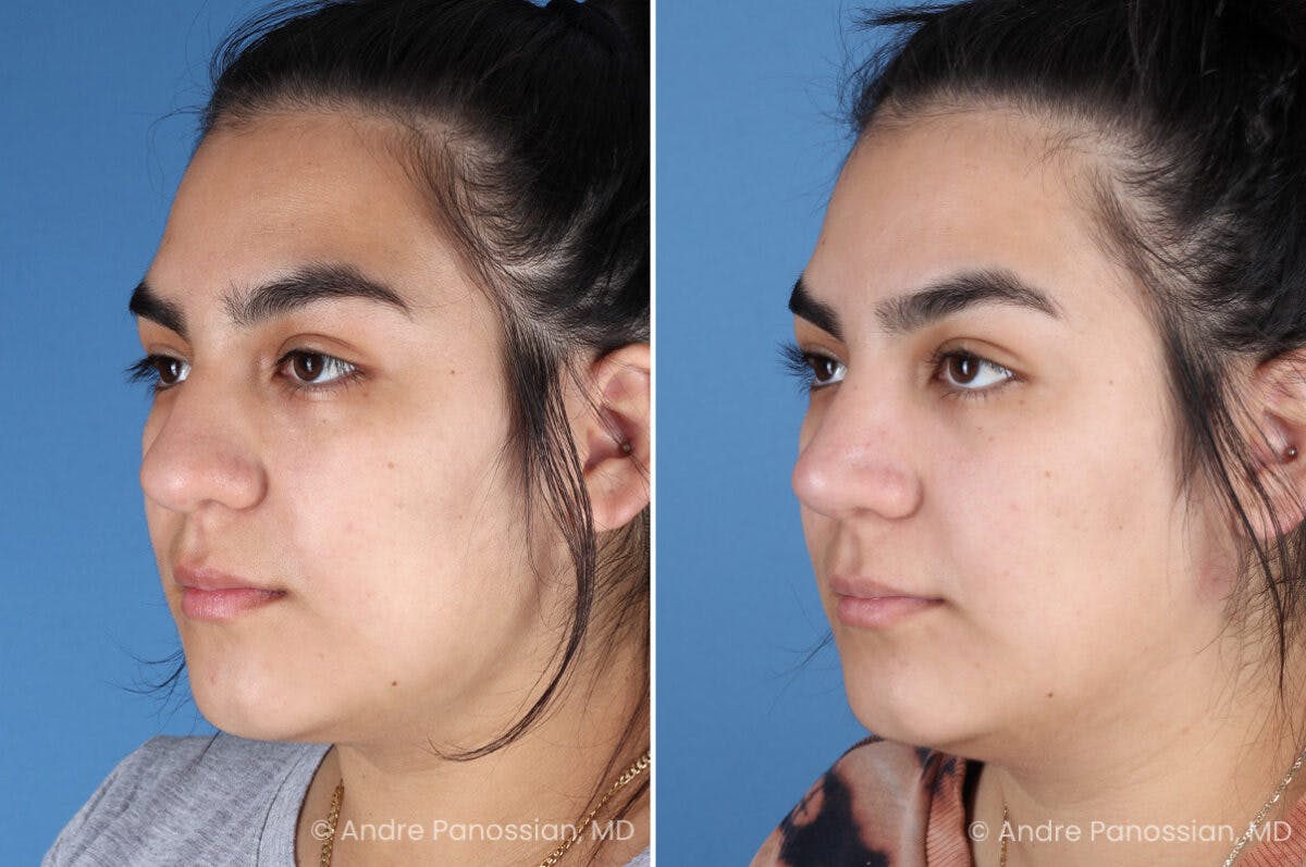 Rhinoplasty Before & After Gallery - Patient 131106 - Image 5