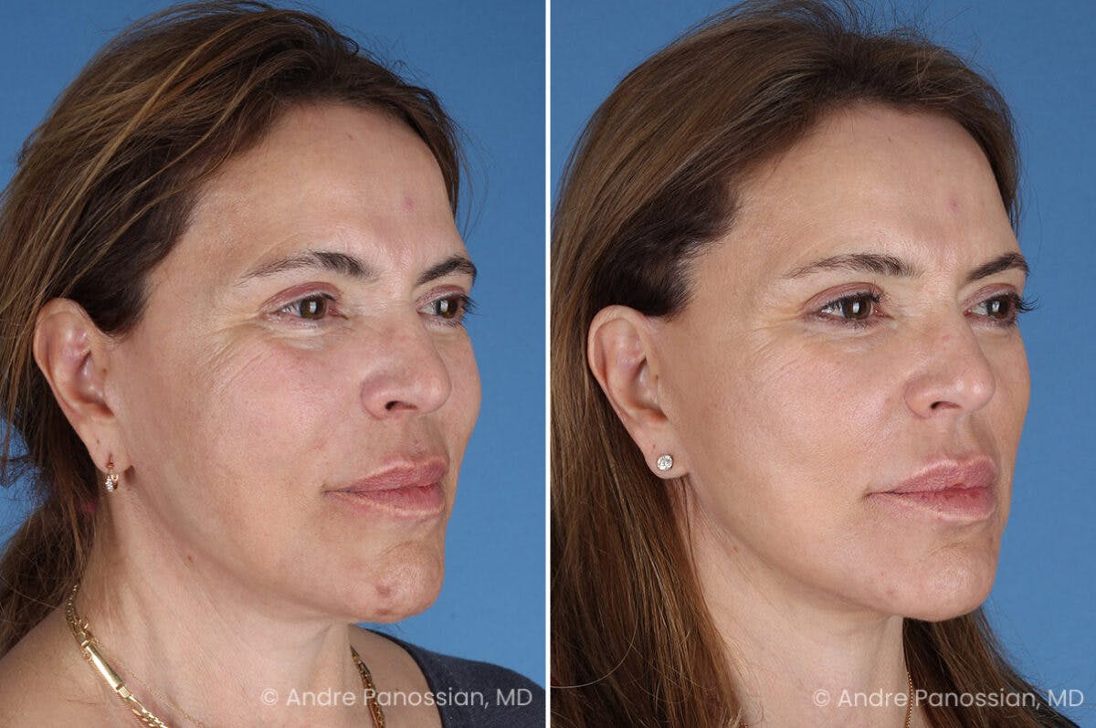 Facelift & Neck Lift Before & After Gallery - Patient 219610 - Image 2