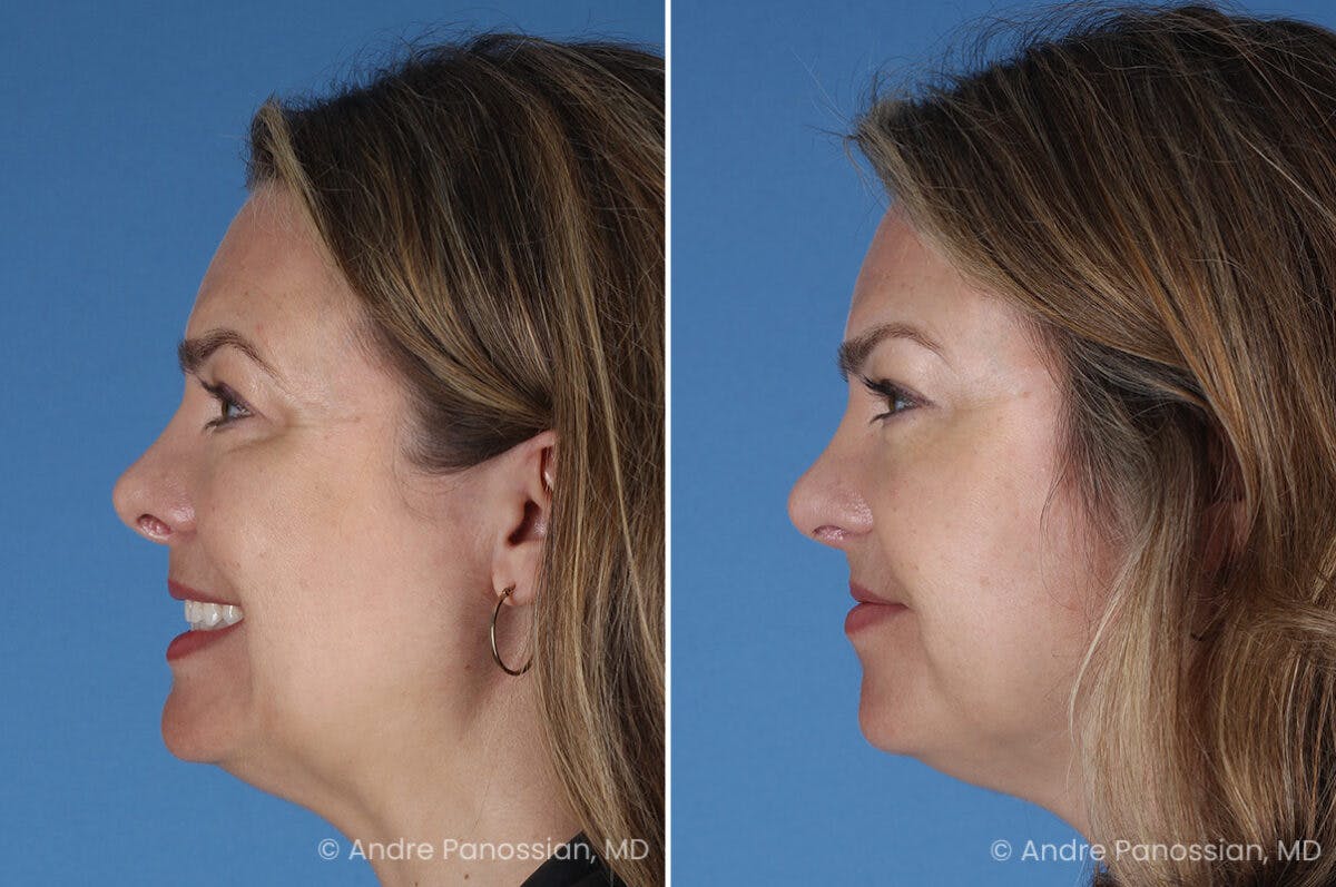 Cleft Lip Rhinoplasty Before & After Gallery - Patient 385231 - Image 6