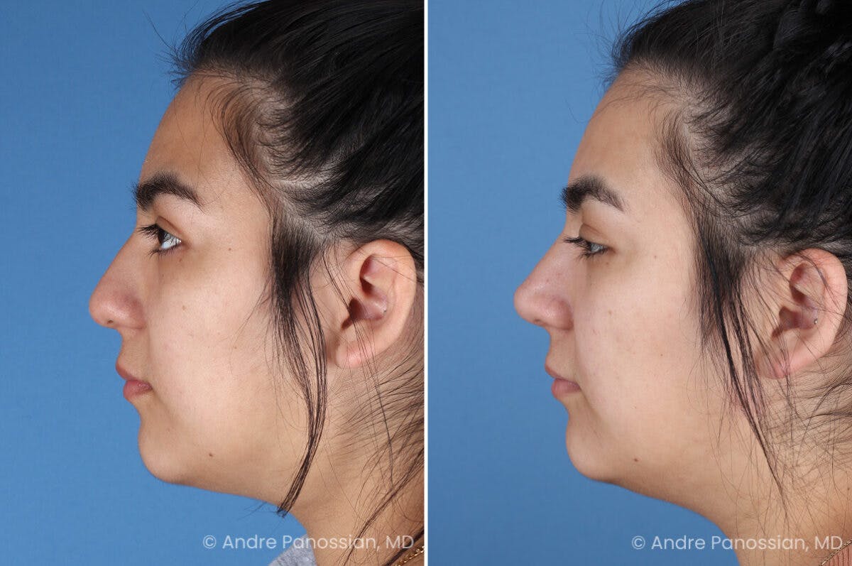 Rhinoplasty Before & After Gallery - Patient 131106 - Image 6