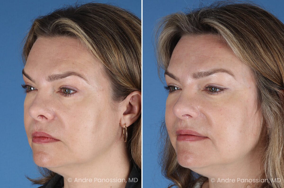 Cleft Lip Rhinoplasty Before & After Gallery - Patient 385231 - Image 7