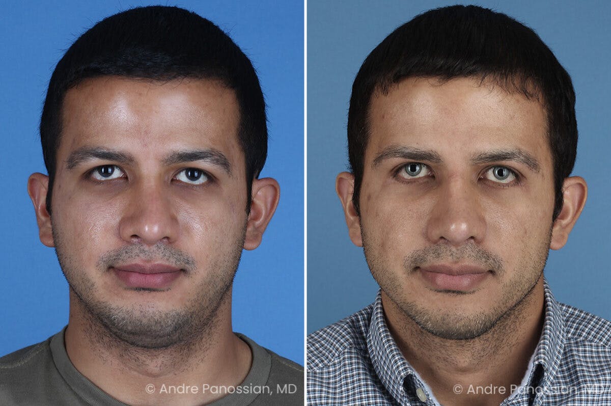 Revision Rhinoplasty Before & After Gallery - Patient 281034 - Image 2