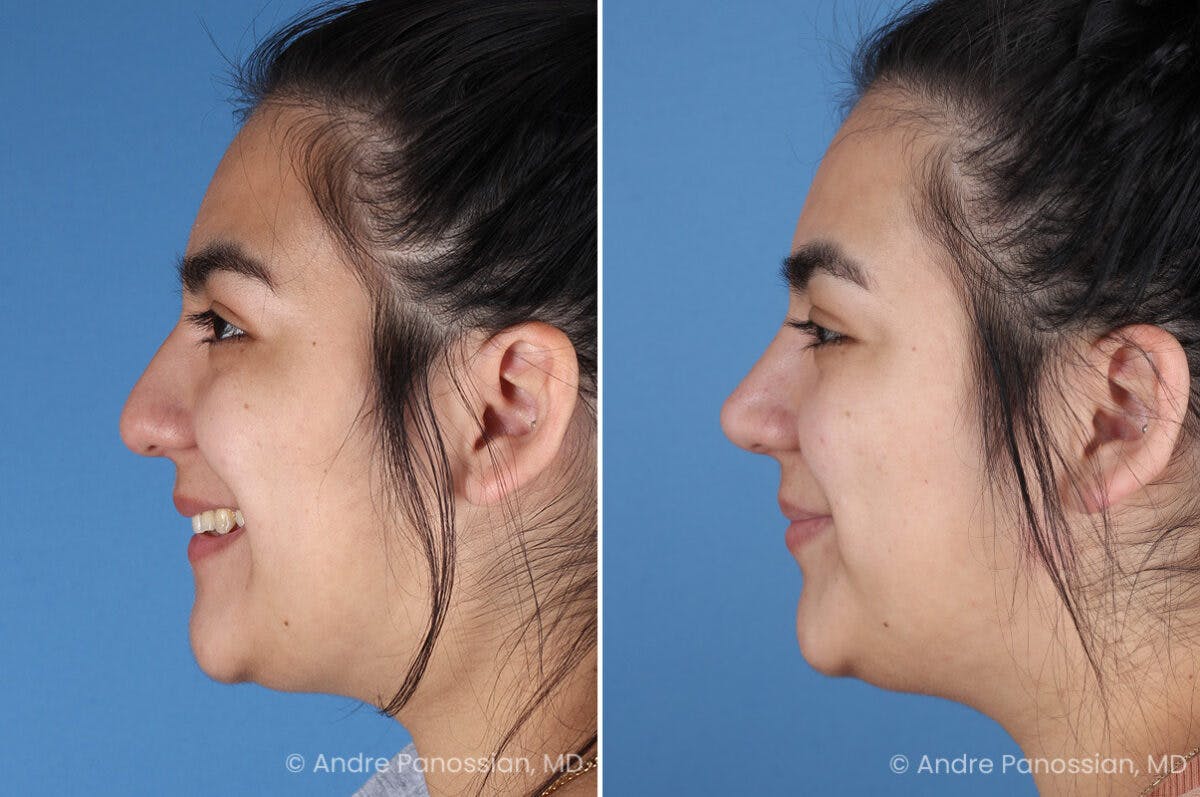 Rhinoplasty Before & After Gallery - Patient 131106 - Image 7