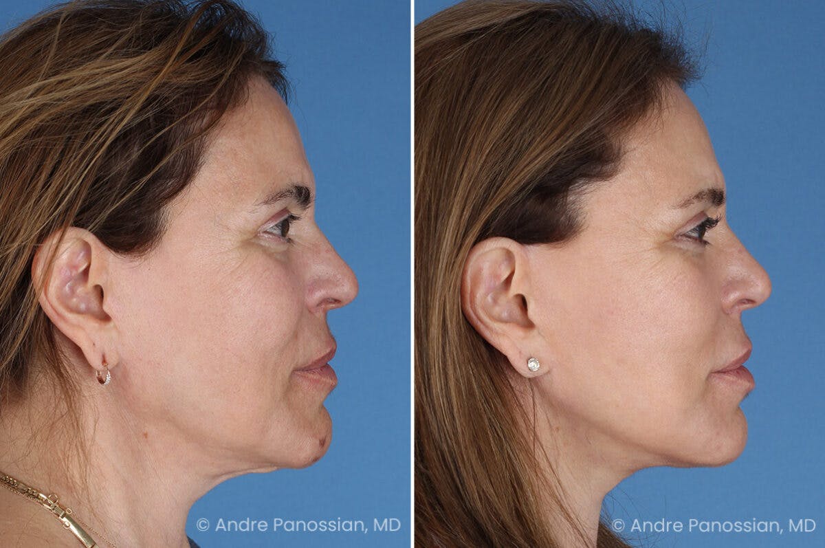 Facelift & Neck Lift Before & After Gallery - Patient 219610 - Image 3
