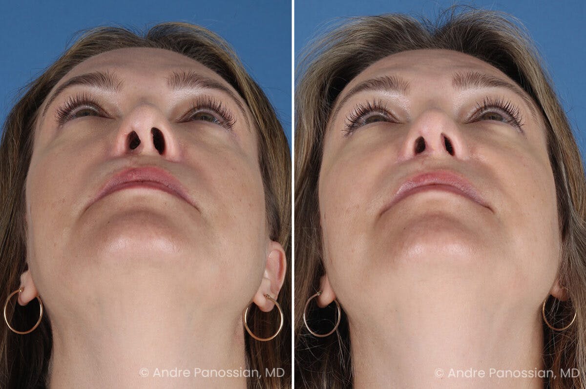 Cleft Lip Rhinoplasty Before & After Gallery - Patient 385231 - Image 8