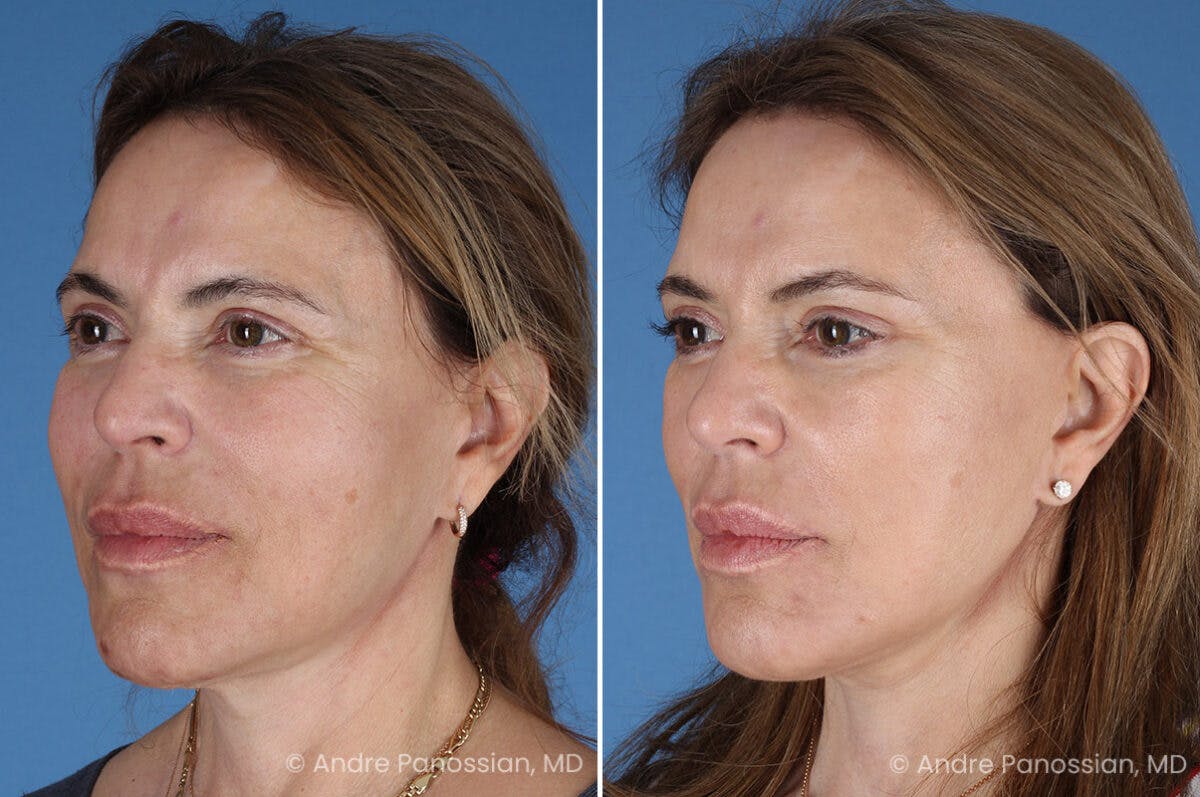 Facelift & Neck Lift Before & After Gallery - Patient 219610 - Image 4