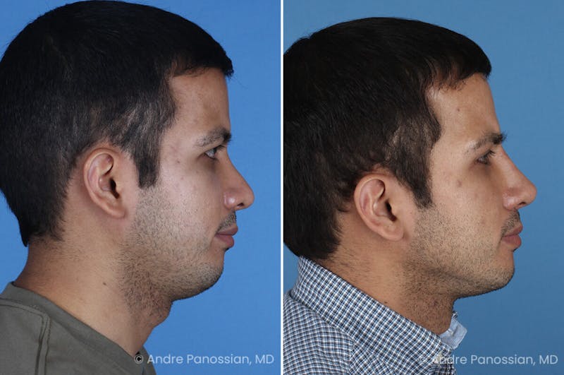 Revision Rhinoplasty Before & After Gallery - Patient 281034 - Image 1