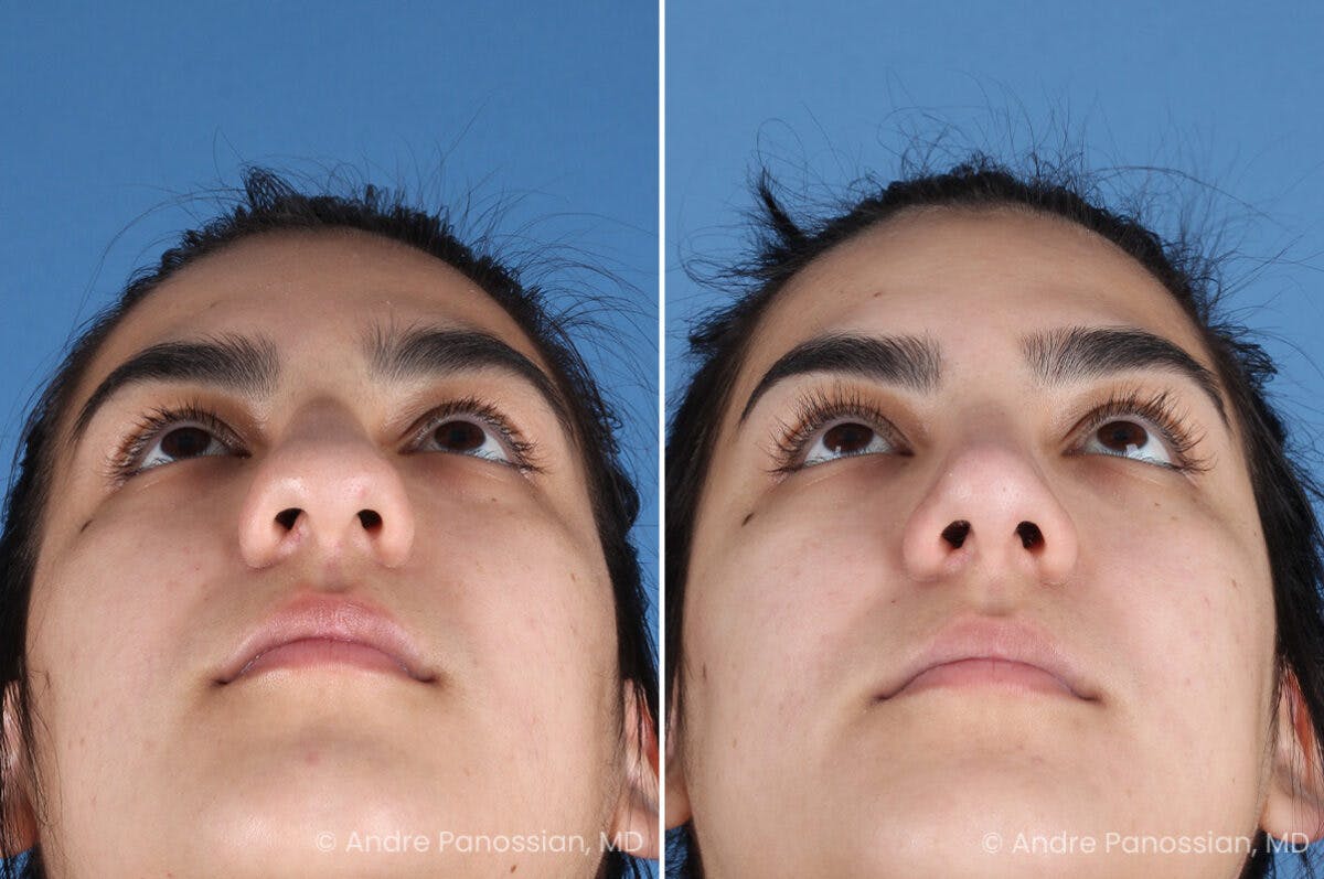 Rhinoplasty Before & After Gallery - Patient 131106 - Image 8
