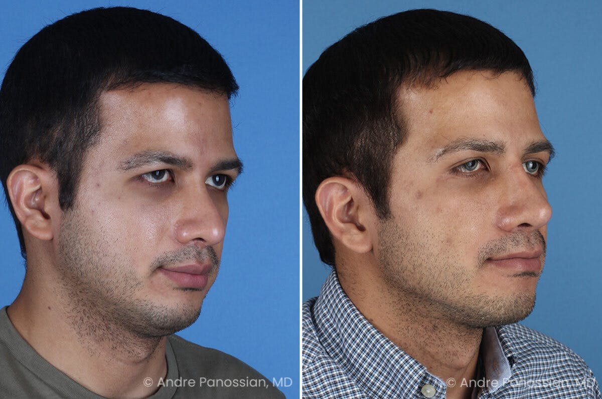 Revision Rhinoplasty Before & After Gallery - Patient 281034 - Image 3