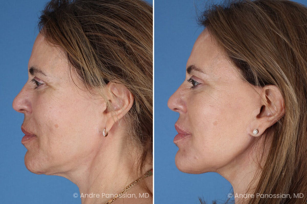 Facelift & Neck Lift Before & After Gallery - Patient 219610 - Image 5