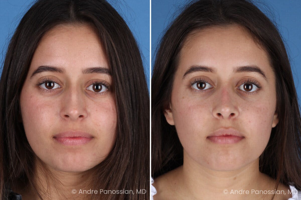 Rhinoplasty Before & After Gallery - Patient 237018 - Image 2