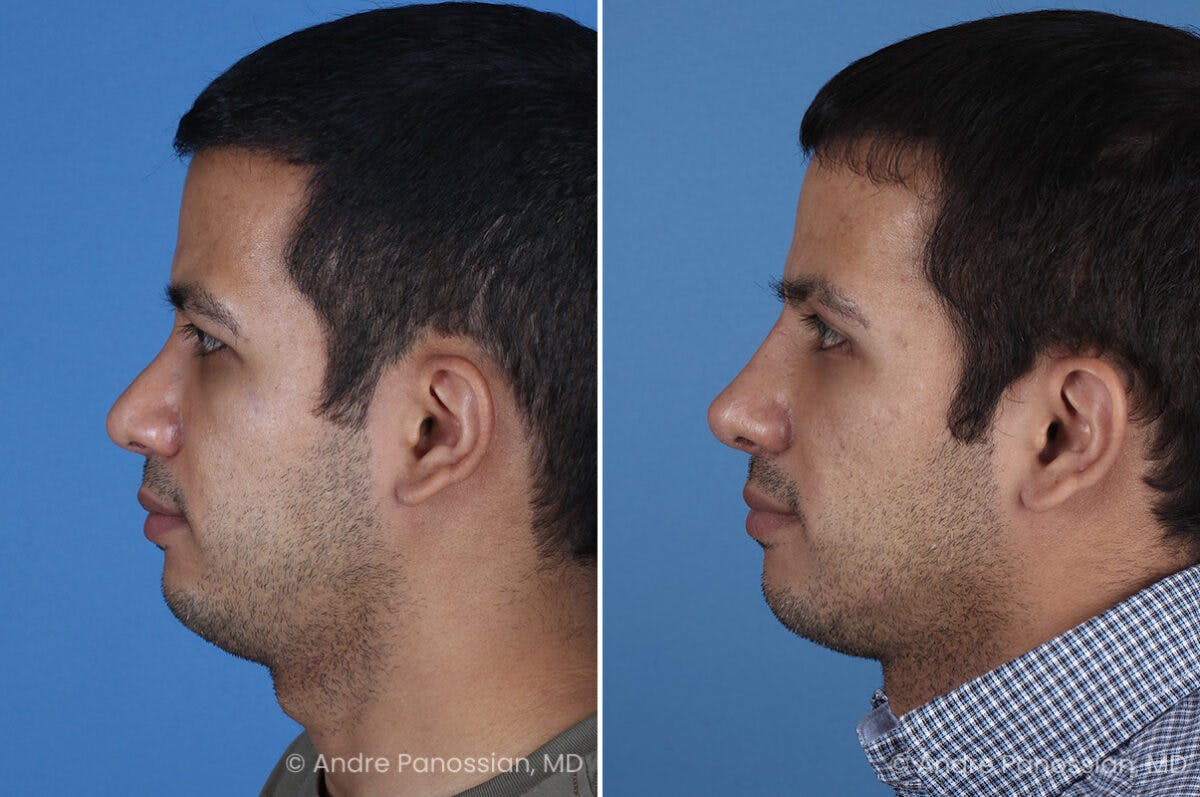 Revision Rhinoplasty Before & After Gallery - Patient 281034 - Image 4