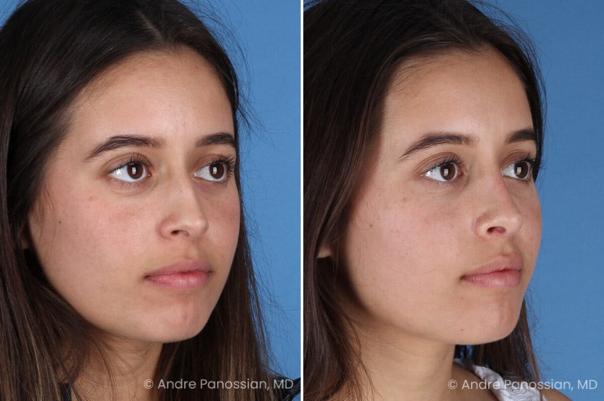 Rhinoplasty Before & After Gallery - Patient 237018 - Image 3