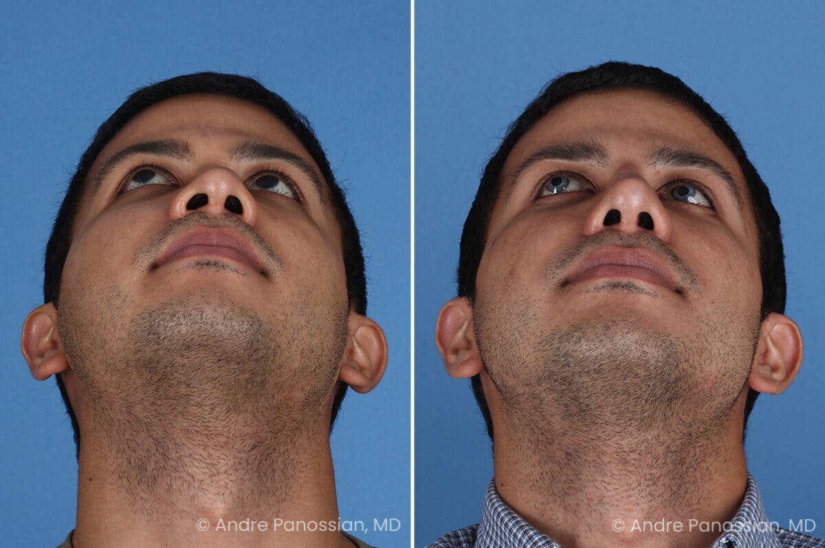 Revision Rhinoplasty Before & After Gallery - Patient 281034 - Image 5