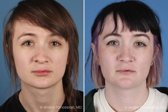 Cleft rhinoplasty before and after — actual patient of Andre Panossian, MD