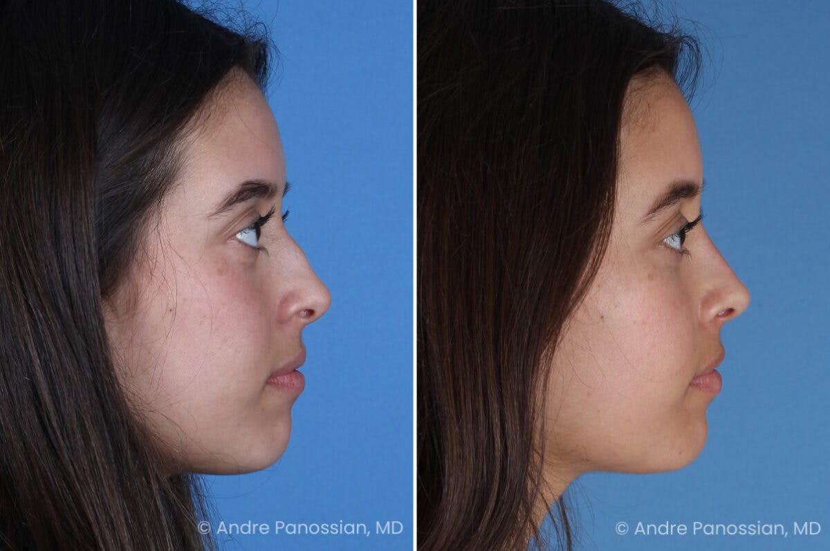 Rhinoplasty Before & After Gallery - Patient 237018 - Image 1