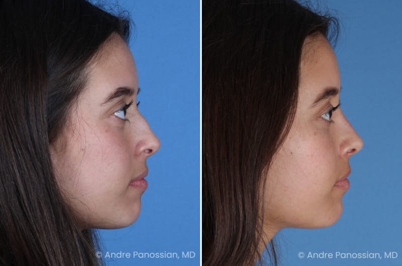 Rhinoplasty Before & After Gallery - Patient 237018 - Image 1
