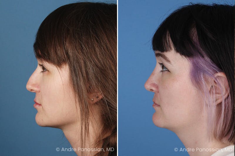 Cleft Lip Rhinoplasty Before & After Gallery - Patient 272326 - Image 1