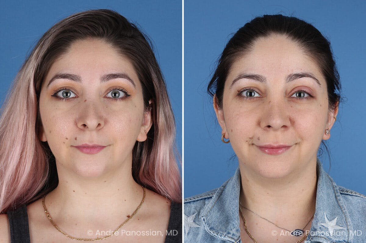 Revision Rhinoplasty Before & After Gallery - Patient 396439 - Image 2