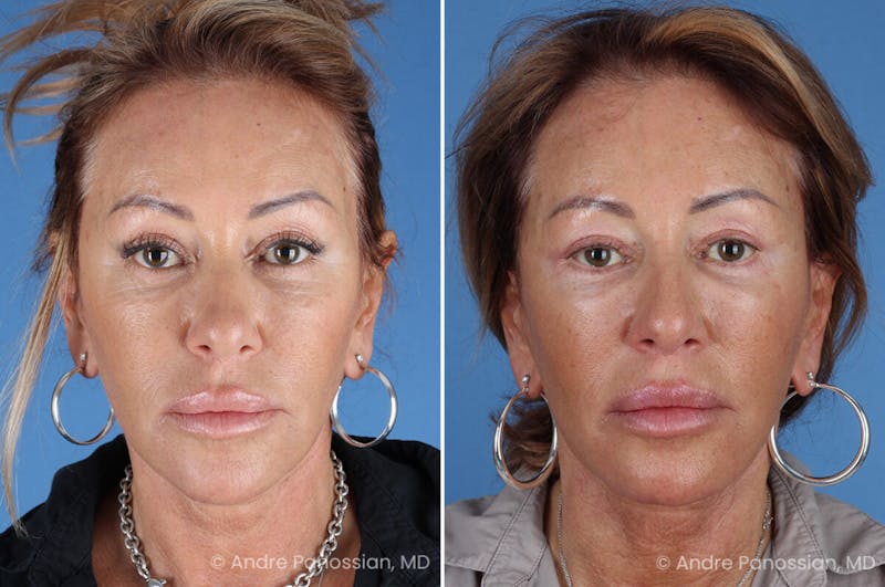 Facelift & Neck Lift Before & After Gallery - Patient 118647 - Image 1