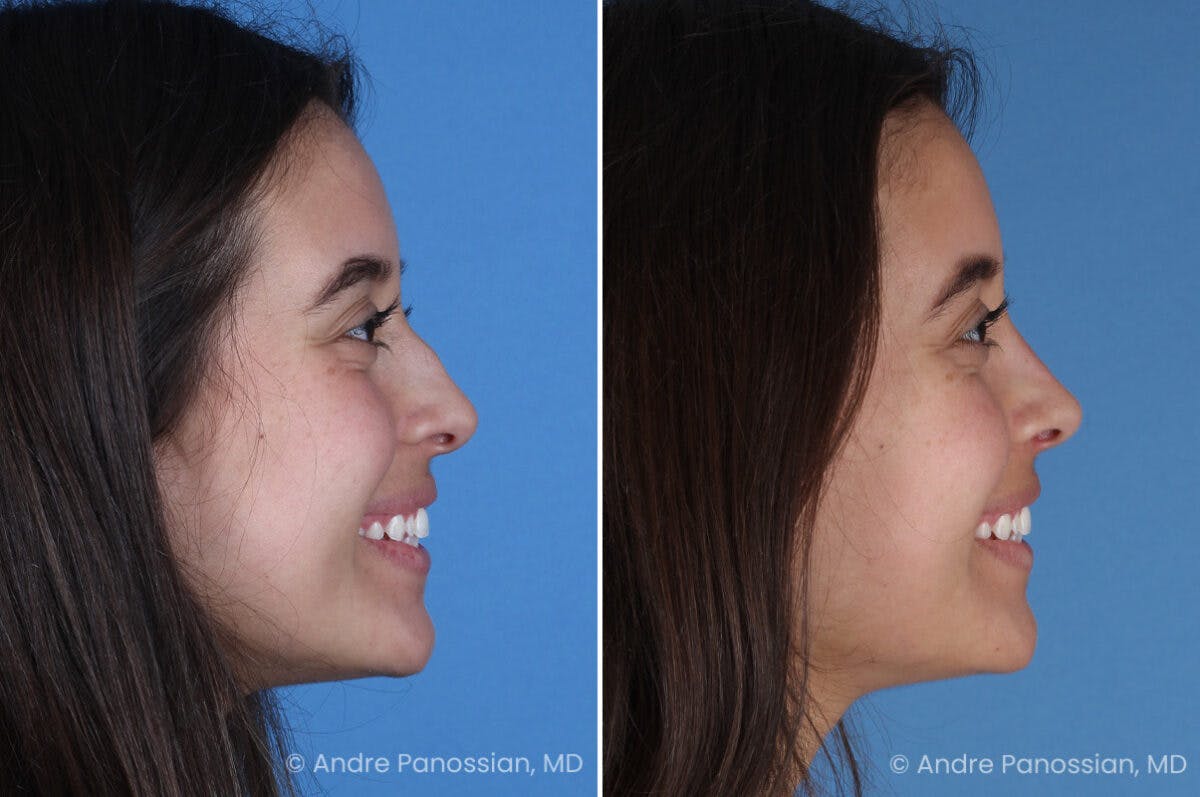 Rhinoplasty Before & After Gallery - Patient 237018 - Image 4