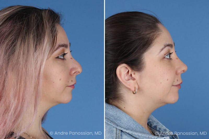 Revision Rhinoplasty Before & After Gallery - Patient 396439 - Image 1