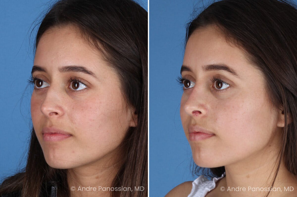 Rhinoplasty Before & After Gallery - Patient 237018 - Image 5