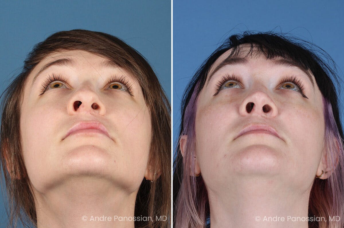Cleft Lip Rhinoplasty Before & After Gallery - Patient 272326 - Image 4