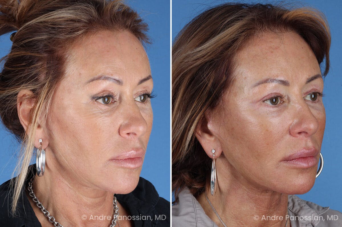 Facelift & Neck Lift Before & After Gallery - Patient 118647 - Image 2