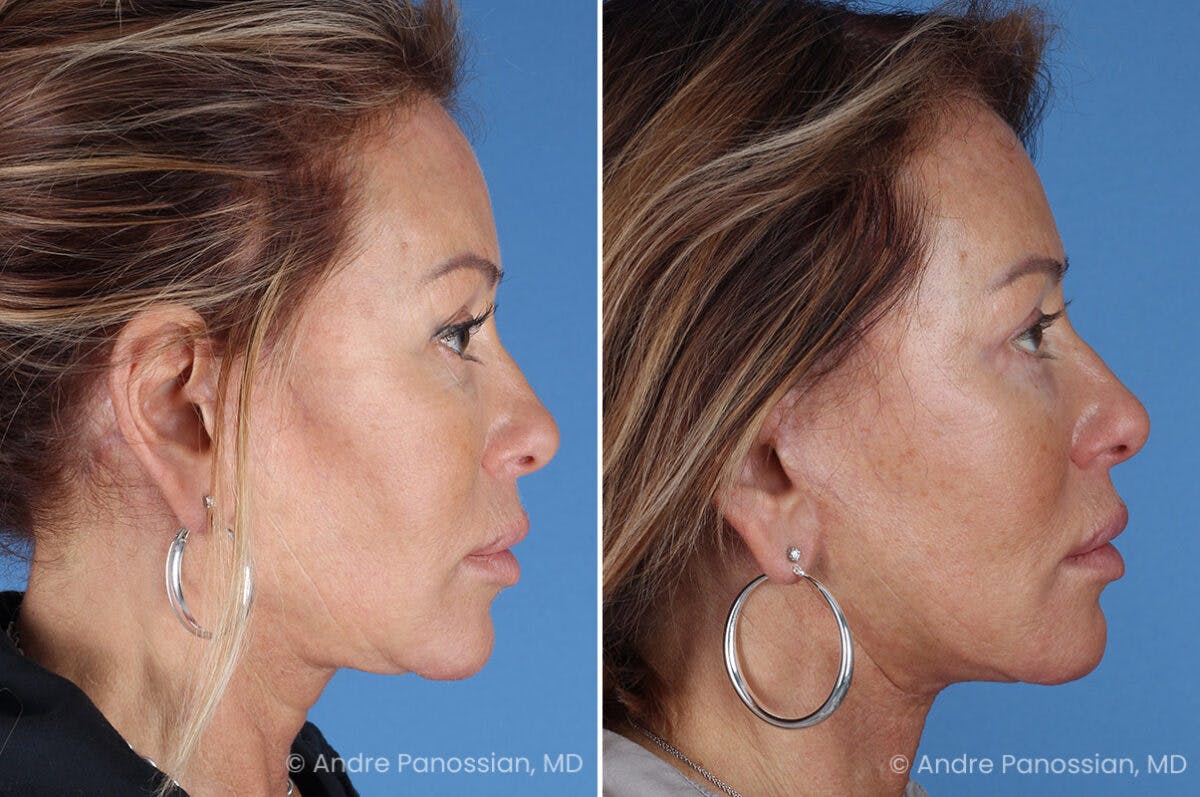 Facelift & Neck Lift Before & After Gallery - Patient 118647 - Image 3