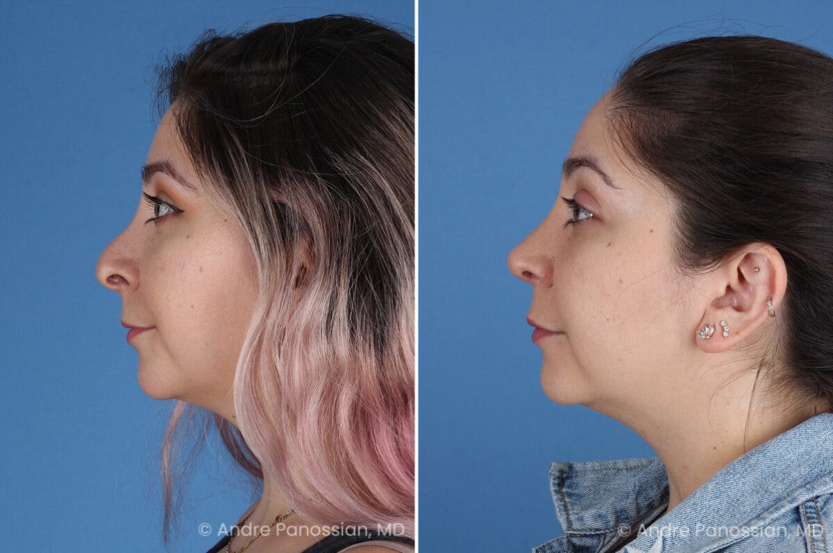 Revision Rhinoplasty Before & After Gallery - Patient 396439 - Image 4