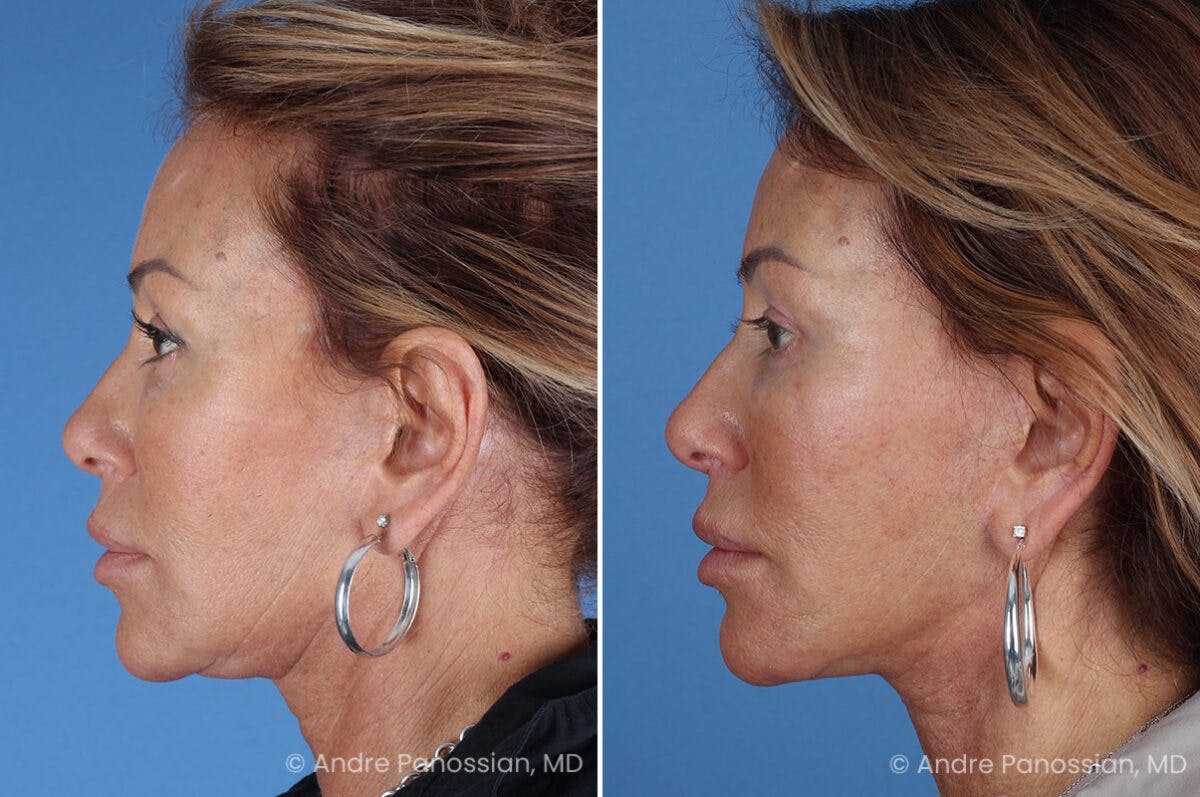 Facelift & Neck Lift Before & After Gallery - Patient 118647 - Image 4