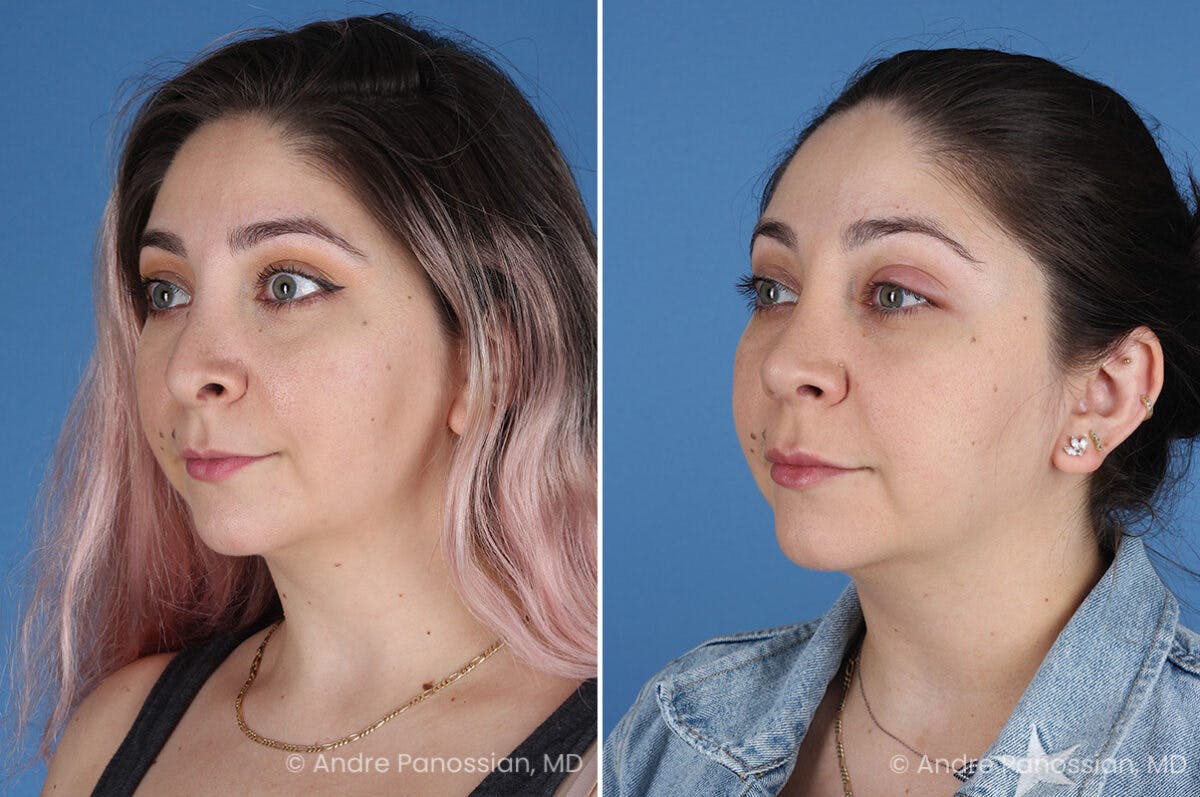 Revision Rhinoplasty Before & After Gallery - Patient 396439 - Image 5