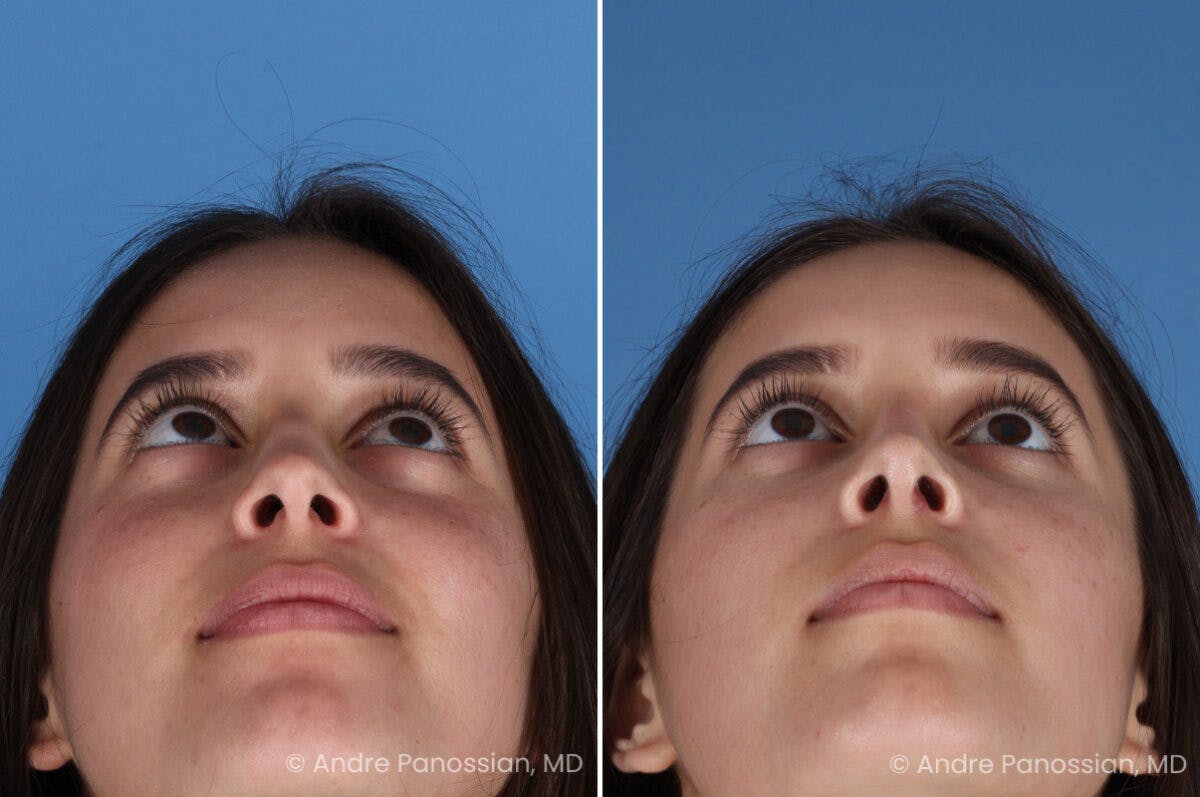 Rhinoplasty Before & After Gallery - Patient 237018 - Image 8