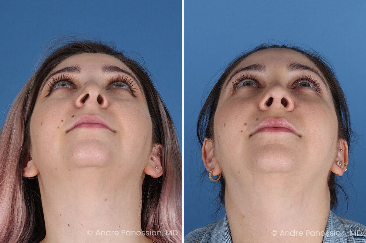 Revision Rhinoplasty Before & After Gallery - Patient 396439 - Image 6