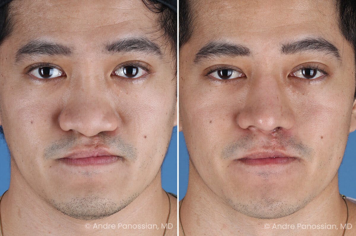 Cleft Lip Rhinoplasty Before & After Gallery - Patient 266817 - Image 2
